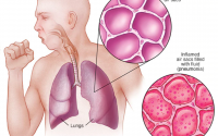 Apa itu Pneumonia?